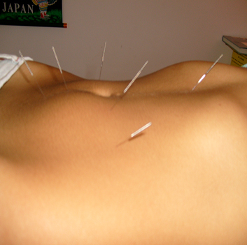 Acupuntura Corporal